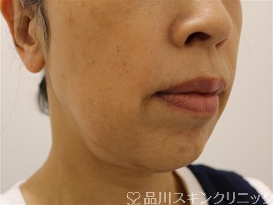 症例NO.43557のBEFORE写真