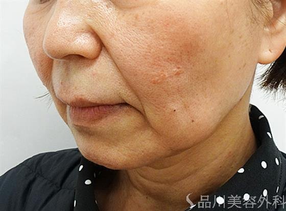 症例NO.47769のBEFORE写真