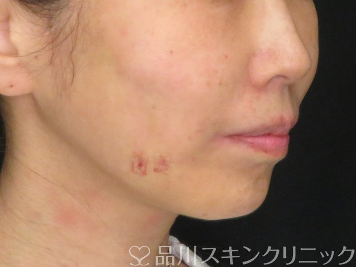 症例NO.65644のAFTER写真
