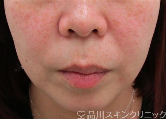 症例NO.35160のBEFORE写真