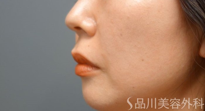 症例NO.65070のAFTER写真