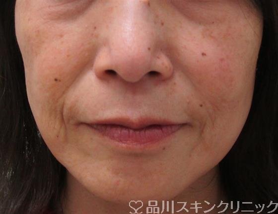 症例NO.30995のBEFORE写真