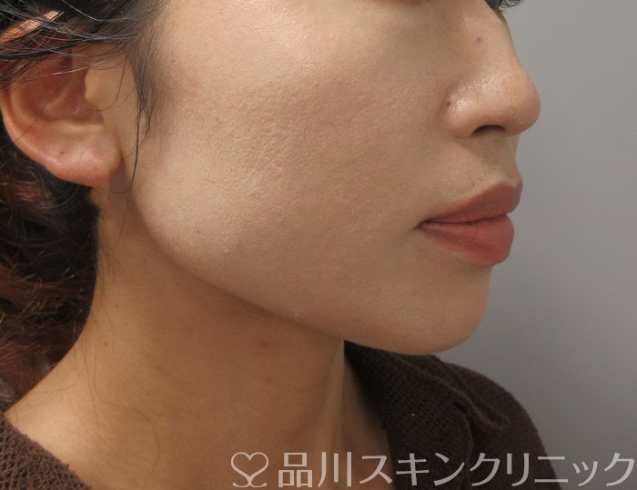 症例NO.74033のAFTER写真