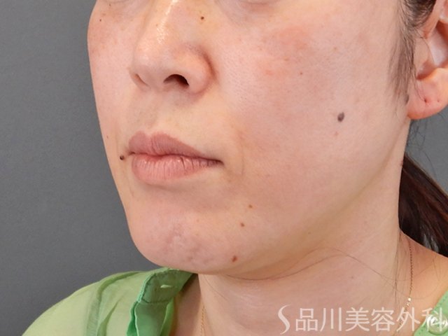 症例NO.75296のBEFORE写真