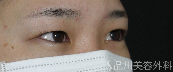 症例NO.72777のBEFORE写真