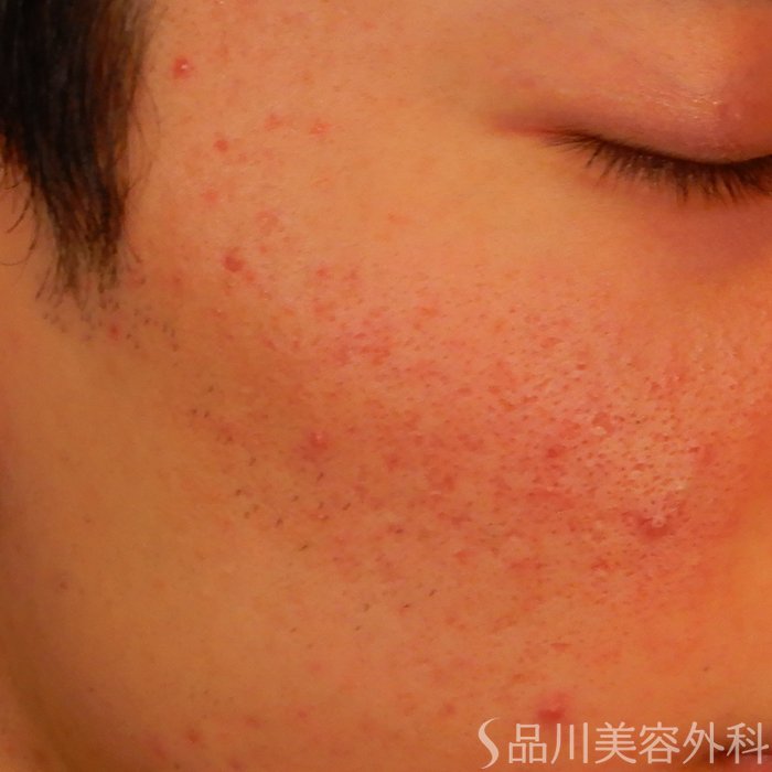 症例NO.67656のBEFORE写真