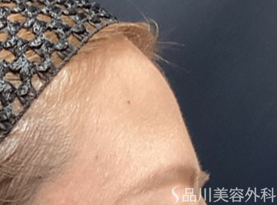 症例NO.74018のBEFORE写真