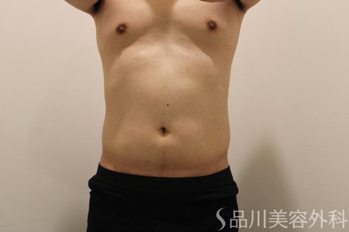 症例NO.75068のBEFORE写真