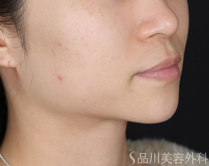 症例NO.72185のBEFORE写真