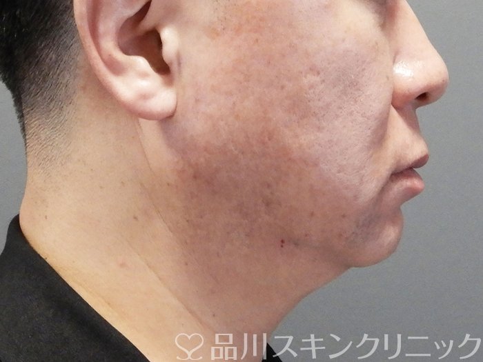 症例NO.73478のAFTER写真