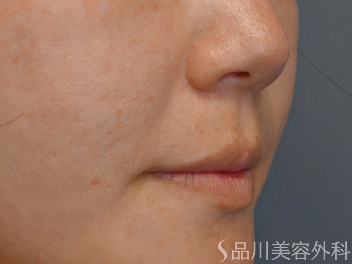 症例NO.71510のBEFORE写真