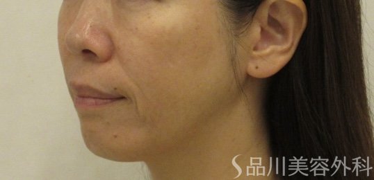 症例NO.72101のBEFORE写真