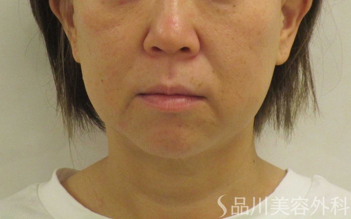 症例NO.64931のBEFORE写真
