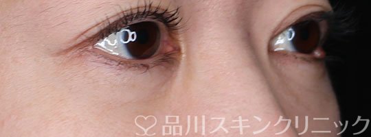 症例NO.70583のAFTER写真