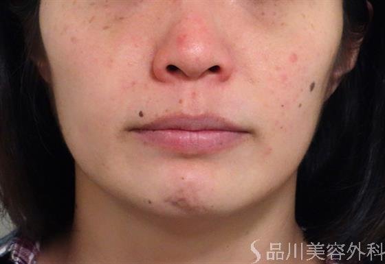 症例NO.35800のBEFORE写真