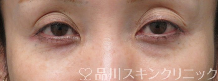 症例NO.74737のBEFORE写真