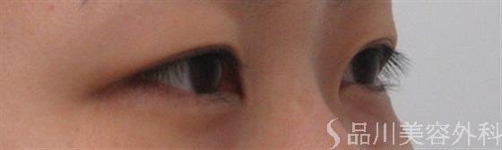 症例NO.30729のBEFORE写真