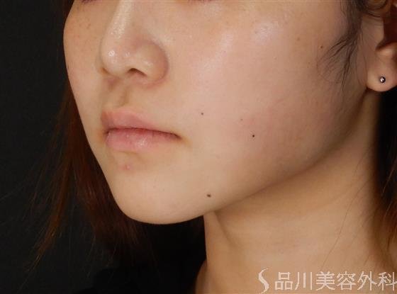 症例NO.60338のAFTER写真