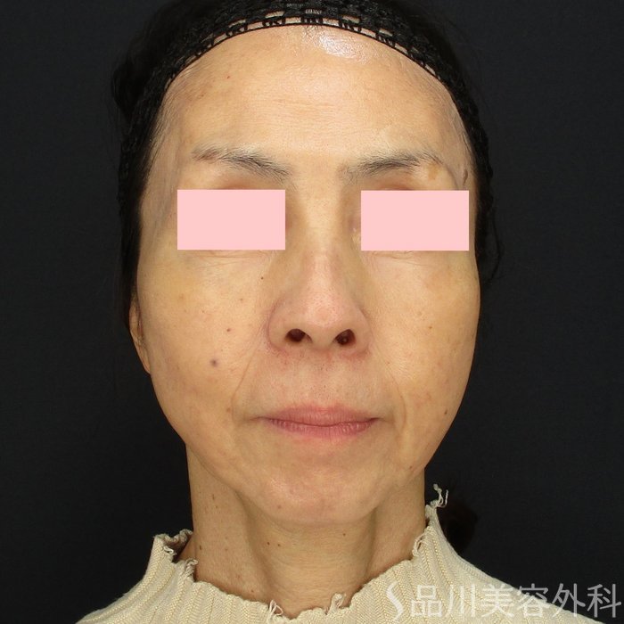 症例NO.72088のAFTER写真