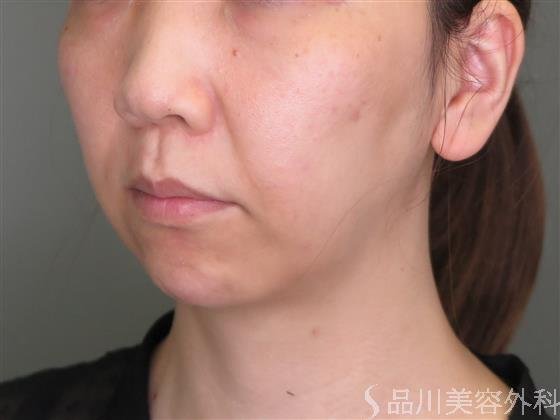 症例NO.48813のBEFORE写真