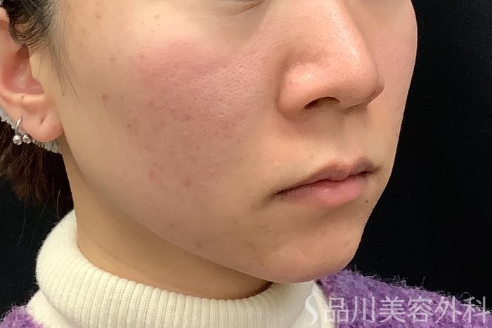 症例NO.65199のBEFORE写真