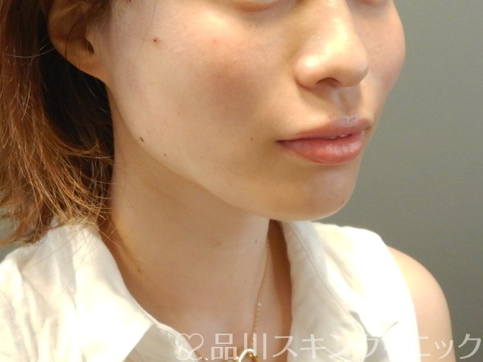 症例NO.65709のAFTER写真
