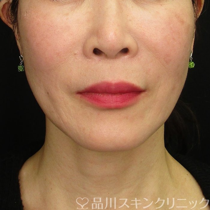 症例NO.70188のBEFORE写真