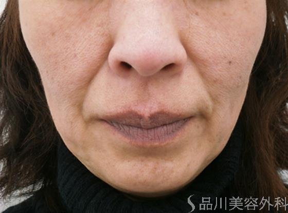 症例NO.27129のAFTER写真