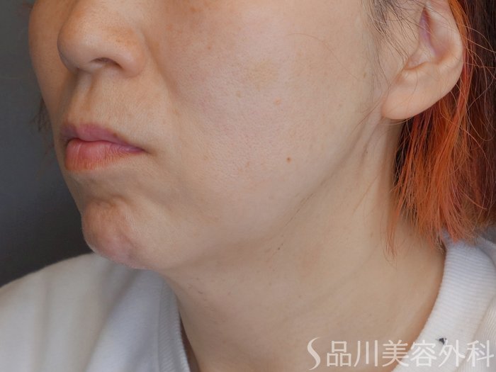 症例NO.70466のBEFORE写真