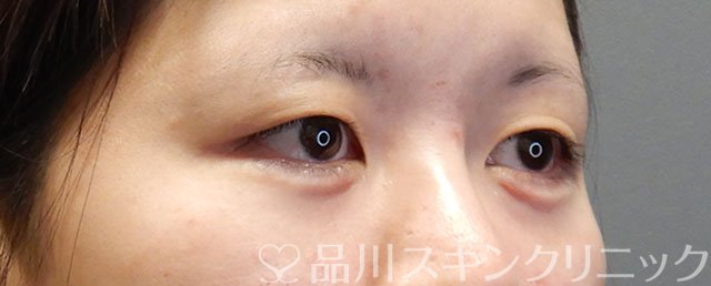症例NO.74493のAFTER写真