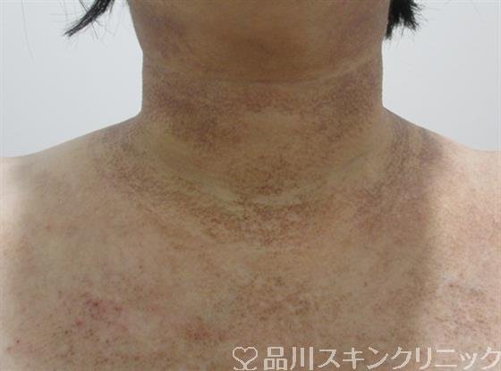 症例NO.41795のBEFORE写真