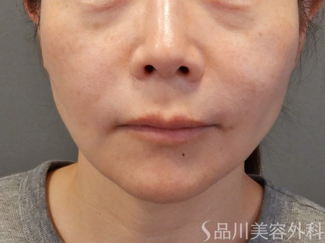 症例NO.74471のBEFORE写真