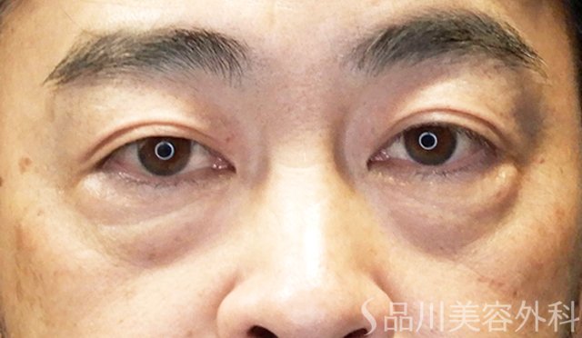 症例NO.65423のBEFORE写真