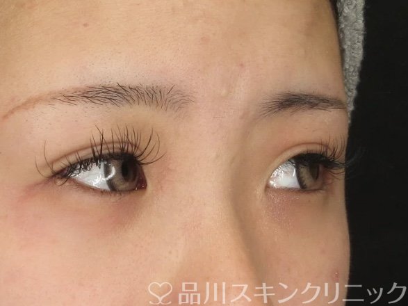 症例NO.69332のAFTER写真