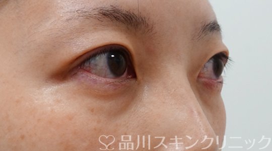症例NO.70672のBEFORE写真