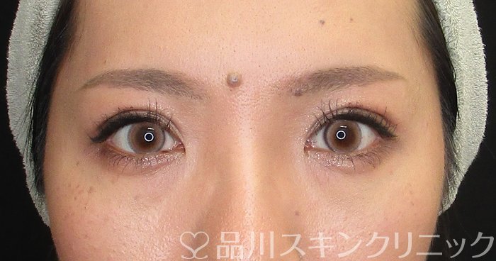 症例NO.73341のAFTER写真