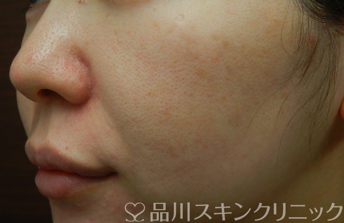 症例NO.66481のBEFORE写真