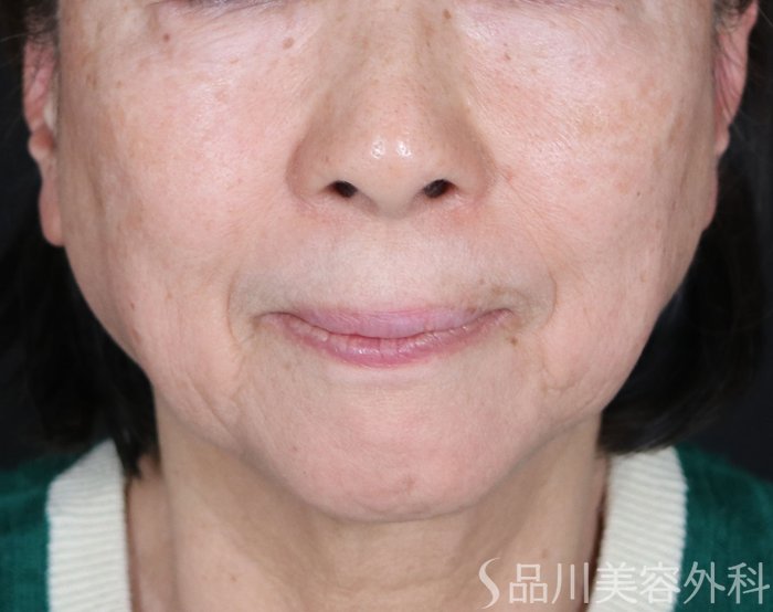 症例NO.73216のBEFORE写真