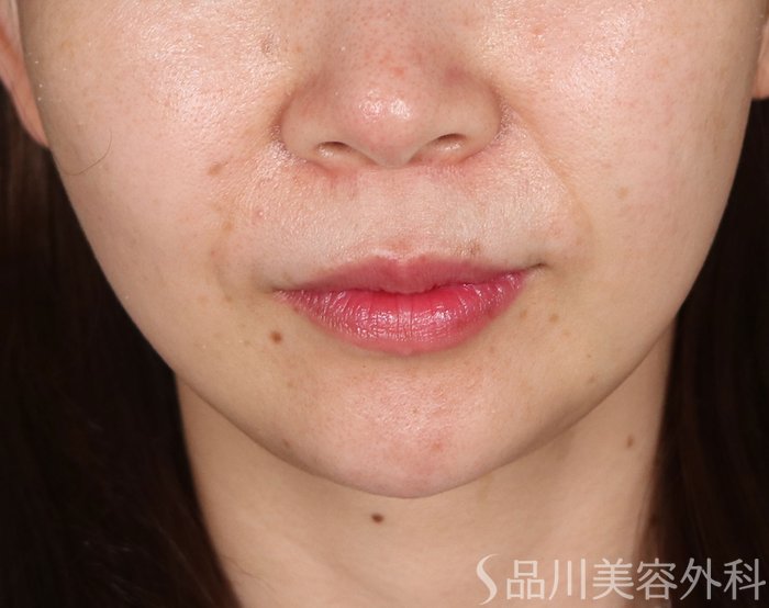 症例NO.73345のBEFORE写真