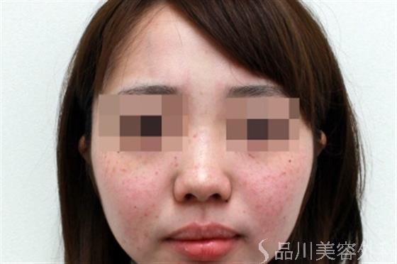 症例NO.21437のBEFORE写真