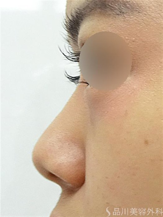 症例NO.42650のBEFORE写真