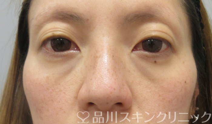 症例NO.73870のBEFORE写真