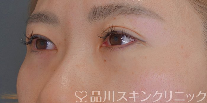 症例NO.73299のAFTER写真