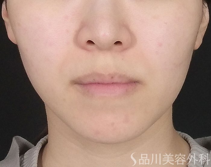 症例NO.65392のBEFORE写真