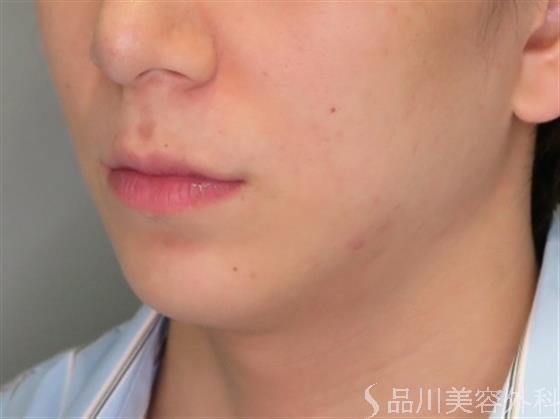 症例NO.47513のAFTER写真