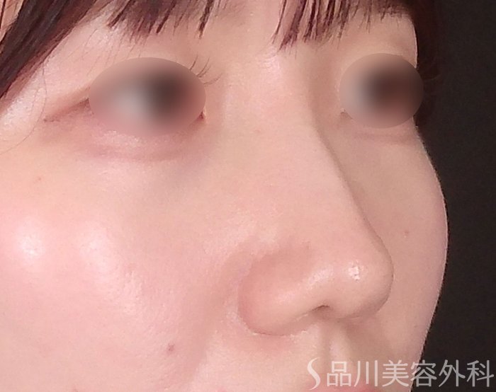 症例NO.69294のAFTER写真