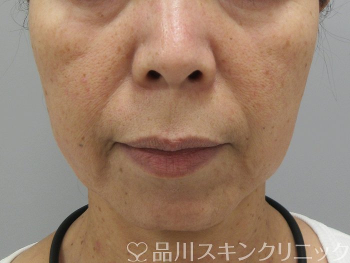 症例NO.74894のBEFORE写真
