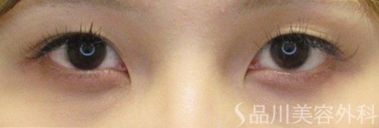 症例NO.70630のBEFORE写真