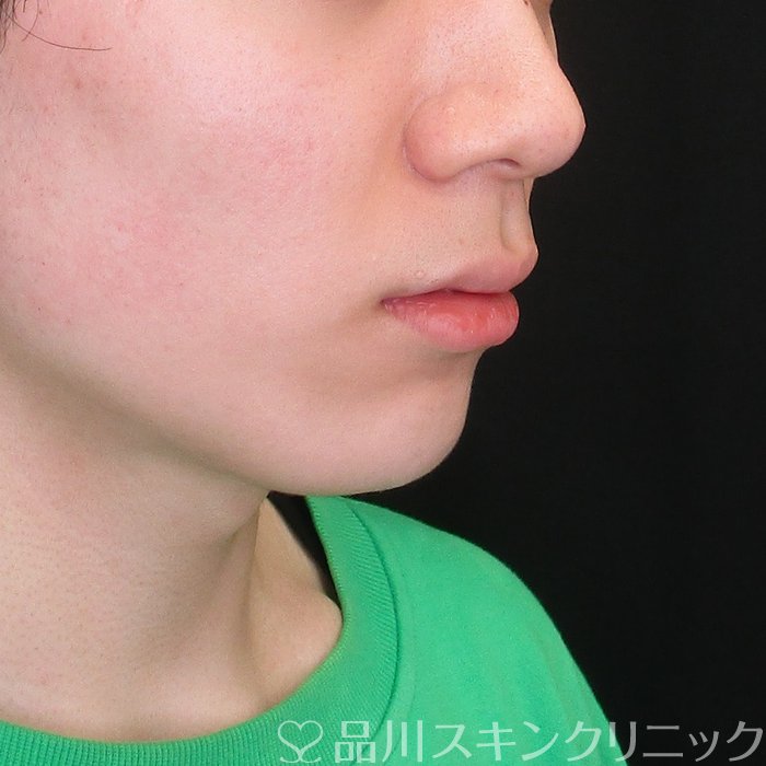 症例NO.73405のAFTER写真