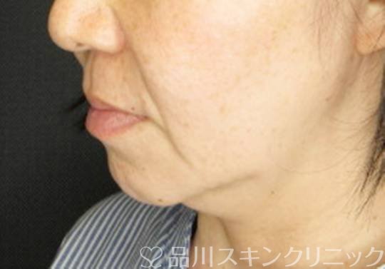 症例NO.75370のBEFORE写真
